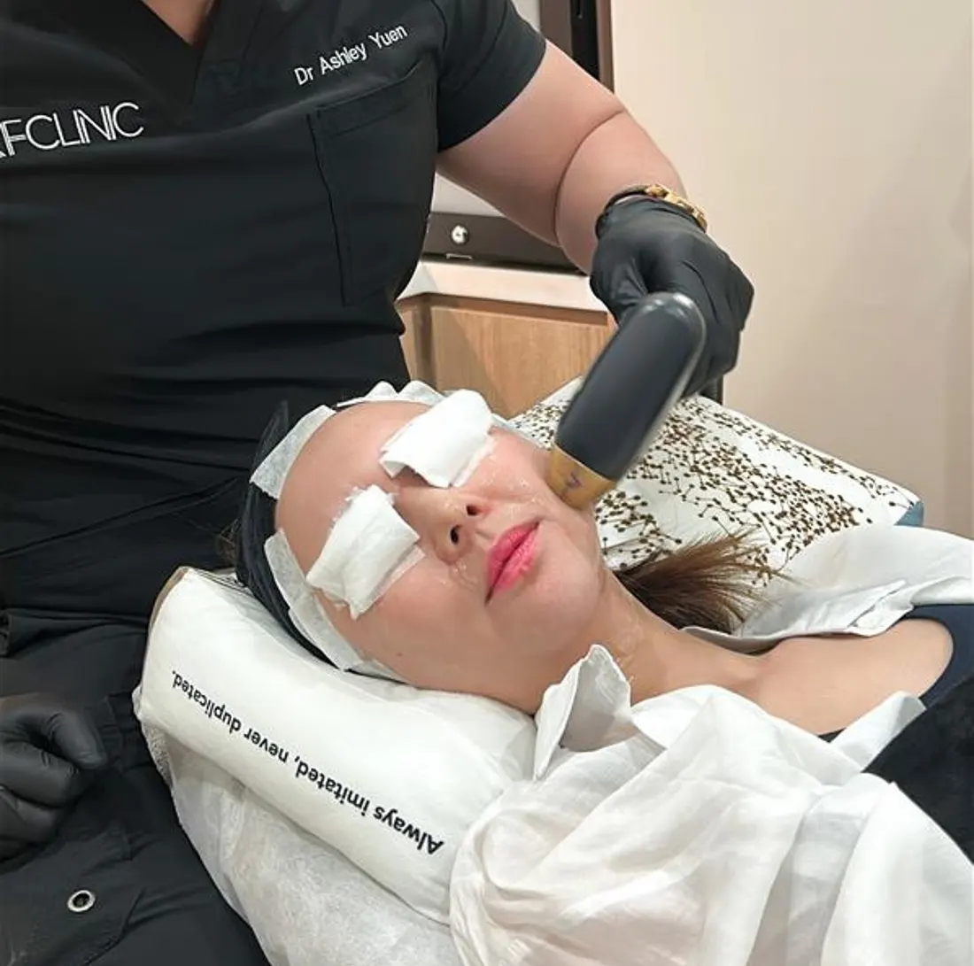 Titanium Lifting Treatment