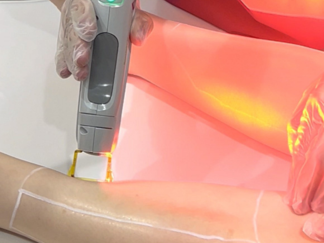 GentleMax Pro™: The Long-Term Solution for Hair Removal