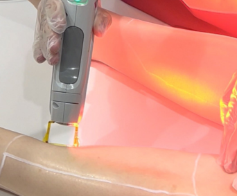 GentleMax Pro™: The Long-Term Solution for Hair Removal