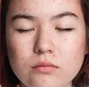 Acne Scars