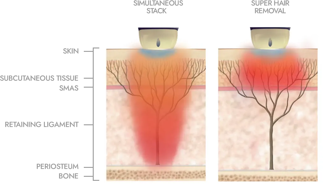 Simultaneous Stack vs Super Hair Removal